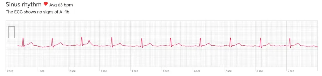 Excerpt from an ECG recorded by the Watch D3: This is how it should look; the subject has no arrhythmias. - What Your Smartwatch ECG Can and Cannot Tell You About Your Heart