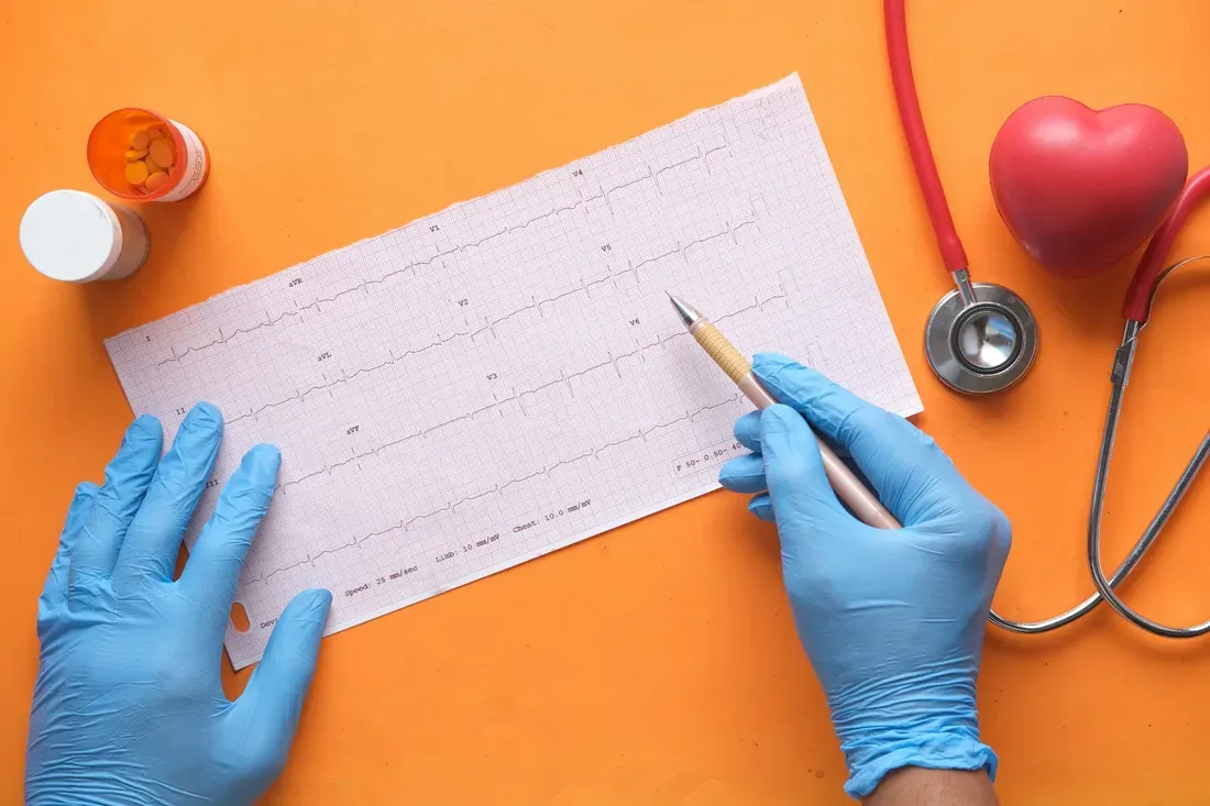 Illustrative image: This is what a multi-lead ECG looks like—interpreting it with pen and paper is still not entirely uncommon. - What Your Smartwatch ECG Can and Cannot Tell You About Your Heart